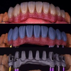 Exocad Dental, Dental Lab Technician, Dental Restoration, Dental Videos, Dental Photography, Teeth Art, Dental Anatomy, Dental Fun