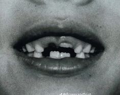 a black and white photo of a child's mouth with teeth missing from it