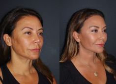 Sagging Cheeks, Facial Aging, Chin Augmentation