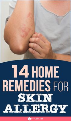 Allergic Reaction Remedies, Skin Rash Remedies, Home Remedies For Rashes, Allergy Rash, Rashes Remedies, Remedies For Skin