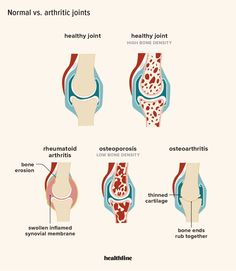 6 Home Remedies for Osteoarthritis Nerdy Nurse, Natural Home Remedies, Home Remedies, How Are You Feeling