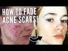 Here are the top ways to remove acne scars fast with scientifically proven results. From acne scar home treatments, acne scarring skincare products, and procedures you can do in office. Acne Pit Scars, Natural Morning, Acne Laser, Face Scrubs, Face Mask For Blackheads, How To Fade, Bad Acne, Face Cleaning, Severe Acne