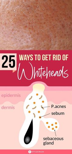 Are you looking for the best ways to get rid of whiteheads? Click here and check out the best at-home remedies and over-the-counter treatment options. Remedies For White Heads, Whiteheads On Chin Removal, How To Treat Whiteheads, Diy Whitehead Removal, How To Get Ride Of White Heads On Face, White Head Remedies, Diy Whitehead Removal Face Masks, Face Mask For White Heads, Removing White Heads From Face