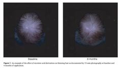 Analyze & Optimize on X: "Topical niacinamide (vitamin B3) restores hair growth. Anything is possible when you focus on metabolism. https://t.co/Zvyiz2QNBB" / X Vitamin B3, Hair Restoration, Anything Is Possible, Vitamins & Supplements