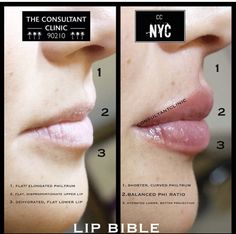 Downturned Lips Filler, Lip Filler Downturned Lips, 1 Ml Lip Filler Before And After, 0.5 Ml Lip Filler Before And After, Natural Lip Fillers