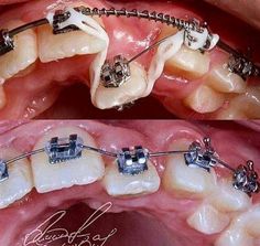 Ortodonzia Orthodontics Teeth, Fix Teeth, Dental Assistant Study, Kedokteran Gigi, Orthodontic Appliances, Dental Photography, Dental Videos