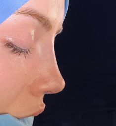 Upturned Nose, Facial Fillers, Nose Surgery