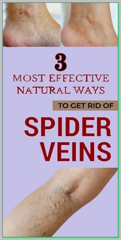 Cardiac Diet, Red Veins, Spider Webs, Health And Beauty Tips