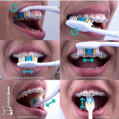 Dental Braces Colors, Braces Smile, Cute Braces Colors, Braces Tips, Getting Braces, Bentuk Alis, Kedokteran Gigi, Cute Braces, Brushing Your Teeth