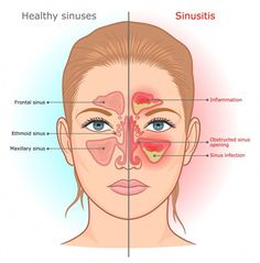 In the past month, I’ve talked to 4 different people who have either had a sinus surgery or had an actual sinus fungal ball! Yesterday at Zumba, my friend Ear Congestion, Clear Your Sinuses, Sinus Congestion Relief, Sinus Congestion, Chest Congestion, Ear Health, Indian Family, Healthy Morning Routine, Natural Cold Remedies