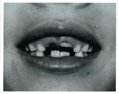 a black and white photo of a person's mouth with braces on it