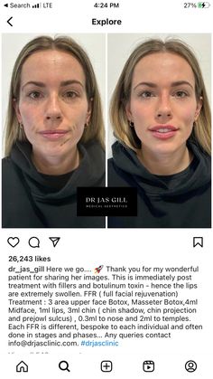 Face Filler Transformation, Fat Grafting Face, Facial Fat Grafting, Face Fat Loss Before And After, Chin Filler Injection, Facial Harmony, Thick Skin Bulbous Tip Rhinoplasty, Jaw Reduction Surgery, Aesthetic Dermatology