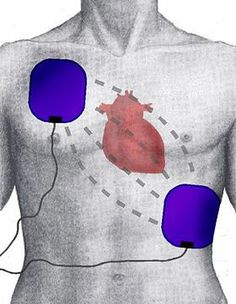 an image of a diagram of the heart and electrodes attached to the back of a man's shirt