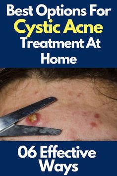 Are you concerned about cystic acne treatment at home? Cystic acne is a type of acne that occurs in the deeper layers of the skin. It can be caused by excess Home Remedies For Cysts, Cystic Acne Remedies, Bad Acne, Under The Skin, Skin Care Order