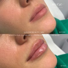 Super Natural Lip Filler, Upper Lip Filler Before And After, Mini Lip Filler, Natural Lip Fillers Before And After, 1 Ml Lip Filler Before And After, 0.5ml Lip Filler Before And After, Subtle Lip Filler Before And After, Subtle Lip Filler, 0.5 Ml Lip Filler Before And After