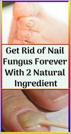 Natural Cures for Toenail Fungus - 3 Simple and Effective Natural Cures for Toenail Fungus by Nina Bliznakovska | This newsletter was created with Smore, an online tool for creating beautiful newsletters for educators, nonprofits, businesses and more Nail Remedies, Nail Infection, Fungal Nail, Toenail Fungus, Fungal Infection, Dry Nails, Nail Fungus, Long Term Care, Tea Tree Essential Oil