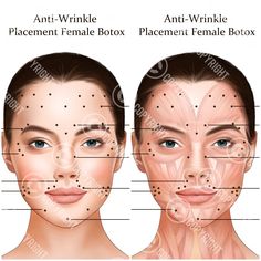 Botox Injection Points, Botox Injector, Aesthetic Nursing, Botox Facial, Botox Filler