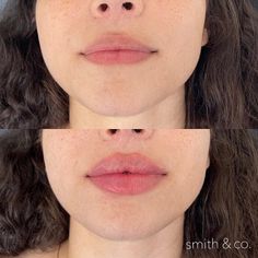 Lip Filler Technique, Lip Lift, Danielle Smith, Facial Contouring, Small Lips, Facial Aesthetics