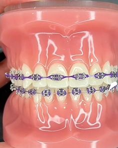 Purple Braces, Getting Braces, Orthodontic Appliances, Brace Face