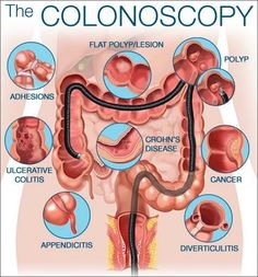 an image of the anatomy of the colonocosyl and how it works for you