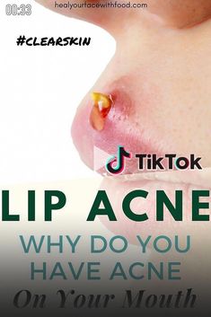 Acne Above Lip Meaning, How To Remove Blackheads From Lip Line, How To Get Rid Of Acne Around Mouth, Lip Pimple How To Get Rid Of, Lip Pimple Remedies Overnight, How To Get Rid Of Lip Pimples, Lip Acne, Pimples On Lip Line