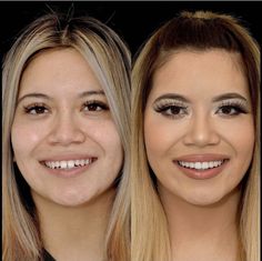 Braces Before And After, Victoria Secret Perfume Body Spray, Dental Aesthetics, Dental Veneers, Perfume Body Spray, Smile Teeth, Smile Makeover