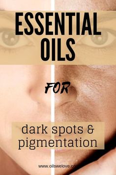 Clearing Hyperpigmentation, Castor Oil For Skin, Acne Cleaning, Essential Oils For Face, Treating Hyperpigmentation, List Of Essential Oils, Dark Spots On Face, Brown Spots On Face, Dark Spots On Skin