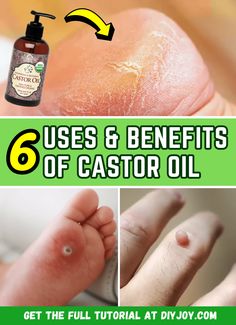 6 Surprising Uses & Benefits Of Castor Oil Castor Oil For Hemmoroids, Castor Oil Skin, Castor Oil Benefits Skin, Castor Oil Pack Benefits, Benefits Of Castor Oil, Castrol Oil, Castor Oil For Skin