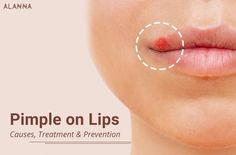 Pimples Around Lips, What Causes Pimples, Lip Pimple, Zit Remedy, Upper Lip Hair Removal, Reduce Hair Growth, Lip Hair Removal, Upper Lip Hair