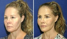 Facelift Surgery, Facelift Before And After, Chin Implant, Facial Contouring, Upper Eyelid, Eye Spy, Visually Pleasing, Eye Lift