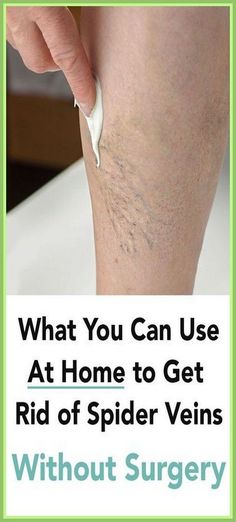 3 NATURAL WAYS TO GET RID OF SPIDER VEINS Get Rid Of Spiders, Homemade Remedies, Plastic Surgeon, Health Info, Protein Shakes, Health Remedies, Natural Healing, Healthy Tips, Get Healthy