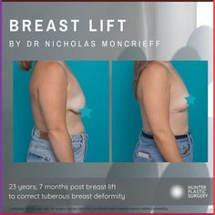 A complex tuberous breast correction case 彩 ✨ SWIPE to see her results from all angles ➡️⁣\n⁣\nThis lovely 23-year-old patient came to see Dr Moncrieff hoping to address her tuberous breast deformity. Dr Moncrieff performed a small breast reduction and uplift to reshape her triangular breasts and create symmetry. Using an internal bra technique, Dr Moncrieff was able to ensure the patient achieved a lifted result that lasts. 😍⁣ Breast Reduction, Breast Lift, Stomach Fat, Tummy Tucks, Cosmetic Surgery, Plastic Surgery