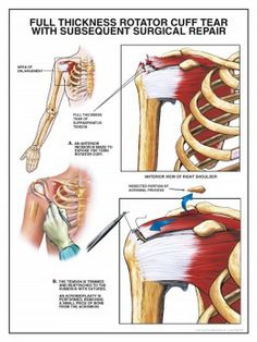 Physical Therapy Exercises, Frozen Shoulder