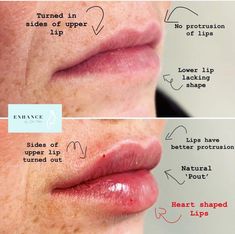 M Shaped Lips With Filler, Lip Filler Before And After Small Lips, Natural Lip Fillers Small Lips, Small Lips Aesthetic, Lip Fillers Juvederm, Full Lips Makeup, Face Makeover, Derma Fillers, Lip Surgery