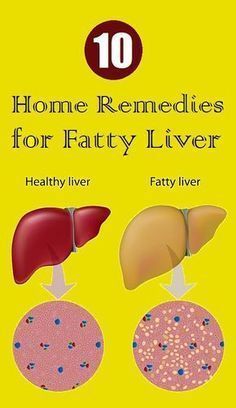 Top 10 Home Remedies for Fatty Liver Top 10 Home Remedies, Detox Your Liver, Detox Diet Plan, Liver Detox, Healthy Liver, Liver Health, Body Detox, Detox Cleanse