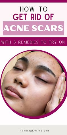 these are ways on how you can reduced acne scars appearence in many option, just try the most that you feel it is for you Feel It