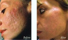 Scar Removal, Chemical Peel, Acne Skin, Skin Care Acne, Skin Rejuvenation, Skin Problems