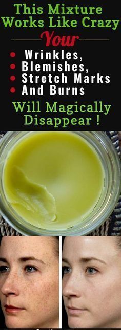 Prepare This Mixture Right Now And Your Wrinkles, Blemishes, Stretch Marks And Burns Will Magically Disappear! Obličejové Masky, Oval Makeup, Beauty Remedies, Wrinkle Cream, Beauty Recipe, Homemade Beauty Products, Beauty Treatments, Belleza Natural, Skin Treatments