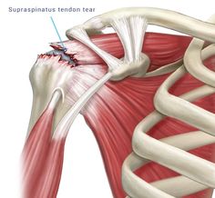 Torn Rotator Cuff Symptoms, Supraspinatus Tendon Tear, Shoulder Acne, Shoulder Dislocation, Shoulder Problem