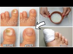 Toenail Health, Nail Health