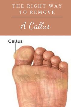 Feet Care Calluses, Foot Scrub Recipe, Homemade Foot Soaks, Best Callus Remover, Foot Soaks, Hand And Foot Care, Nail Infection, Fungal Nail, Health Living