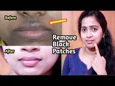 How To Remove Dark Black Patches, Dark Spots, Hyper Pigmentation, Around Your Mouth | DIYA creative Video By #Mahathi Beauty Corner.Subscribe Our Channel..Ho... Darkness Around Mouth, Black Spots On Face, Skin Lightening Diy, Best Dark Spot Corrector, Beauty Corner, Blemish Remover, Dark Spot Corrector