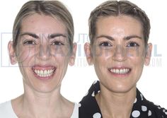 Gummy Smile Correction, Orthognathic Surgery, Gummy Smile, Dental Care, Surgery, Facial