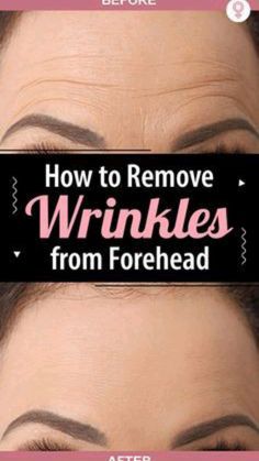 Forehead Wrinkles Remedies, Reduce Forehead Wrinkles, Wrinkles Remedies Face, Wrinkle Remedies, Wrinkle Free Skin, Radiant Beauty, Facial Wrinkles, Body Stretch, Forehead Wrinkles