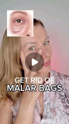 Natalia Gigengak | Natural Face Rejuvenation on Instagram: "The best ways to get rid of malar bags 👇  🔸Self-massage 🔸 Lymphatic drainage techniques 🔸 Taping  Important factors remain:   ✅ correct daily routine ✅ sufficient physical activity ✅ compliance with the water drinking regime ✅ to get rid of bad habits.  Stay Young & Feel Young ❤️ . . . . . . . . . . . . . . . . . . #wrinklesbegone #wrinklesundereyes #crowsfeetbegone #crowsfeet #undereyesbags #undereyecircles #undereyewrinkles #facialsculpting #sculptmassage #facialyoga #facialfitness #faceyogaforall #hoodedeyes #swallenface #nasolabialfolds #naturalskincare #naturalfacelift #naturaleyelift #faceliftingmassage #loveyourselftoday #beautyroutines #fabulousat40 #fabulousat50 #noninvasive #nonsurgical #nobotox" Malar Bags Remedy, How To Get Rid Of Eye Bags Naturally, How To Get Rid Of Bags Under Eyes Fast, How To Get Rid Of Bags Under Eyes, How To Get Rid Of Puffy Eyes, How To Get Rid Of Eye Bags Fast, How To Get Rid Of Eye Bags, Malar Bags, Get Rid Of Eye Bags