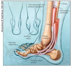 Posterior Tibial Tendon, Bolesti Chrbta, Human Body Anatomy, Shin Splints