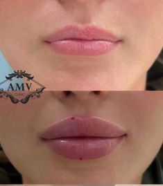 Lip Injections On Small Lips, Lip Filler Contour, Russian Lip Filler Aesthetic, Lip Filler No Cupids Bow, Big Lip Filler, Angelic Lip Filler, M Shape Lip Filler, Lip Filler Examples, Rounded Lip Filler