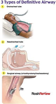 three types of definitive airways in the neck and upper arm, with instructions on how to use them