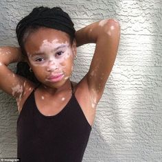 Inspiration: April Star, 10, an aspiring fashion model with vitiligo has over 62,000 followers on Instagram Black Pinterest, Spring Jewelry, Red Panda, Belleza Natural, Body Skin, Fashion Model