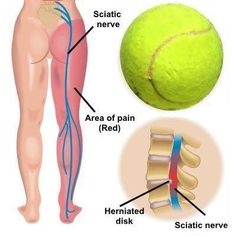 Tennis Ball Massage, Sore Muscle Relief, Psoas Release, Sore Muscle, Hip Problems, Sciatica Relief